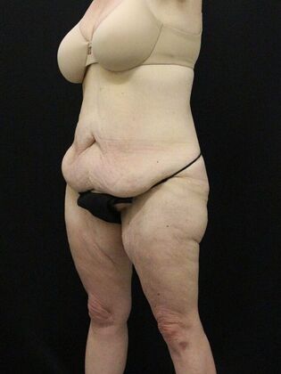 Tummy Tuck: Case 38 - Before