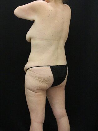 Tummy Tuck: Case 38 - Before