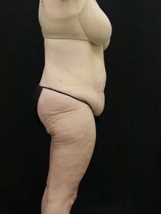 Tummy Tuck: Case 38 - Before