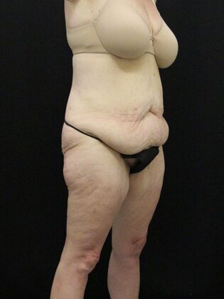 Tummy Tuck: Case 38 - Before