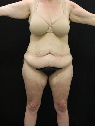 Tummy Tuck: Case 38 - Before