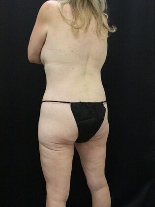 Tummy Tuck: Case 38 - After