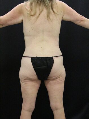 Tummy Tuck: Case 38 - After