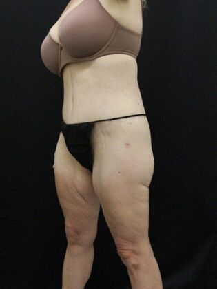 Tummy Tuck: Case 38 - After