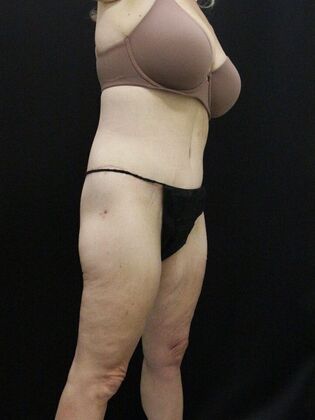 Tummy Tuck: Case 38 - After