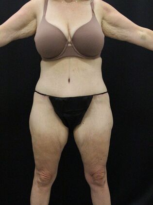 Tummy Tuck: Case 38 - After