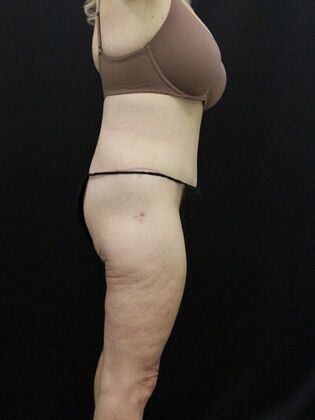 Tummy Tuck: Case 38 - After