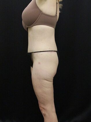 Tummy Tuck: Case 38 - After