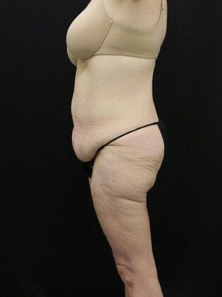 Tummy Tuck: Case 38 - Before