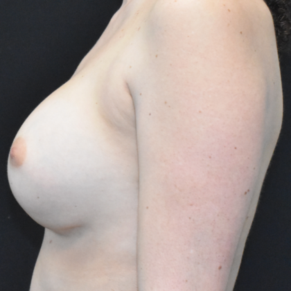 Breast Augmentation: Case 15 - Before