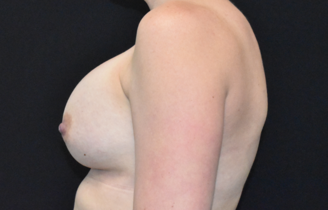 Breast Augmentation: Case 16 - After