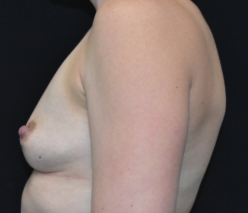 Breast Augmentation: Case 16 - Before