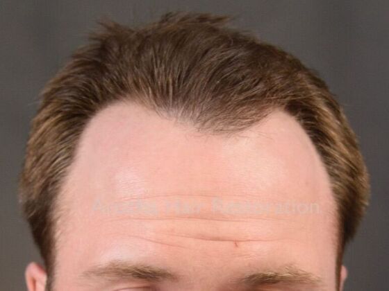 FUE Hair Restoration: Case 35 - After