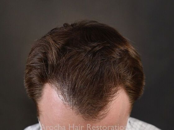 FUE Hair Restoration: Case 35 - After