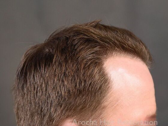 FUE Hair Restoration: Case 35 - After