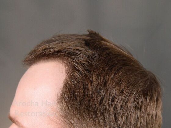 FUE Hair Restoration: Case 35 - After