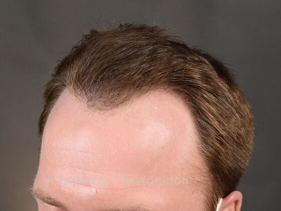 FUE Hair Restoration: Case 35 - After