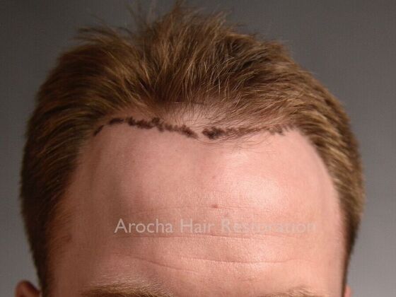 FUE Hair Restoration: Case 35 - Before