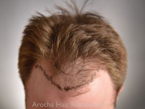 FUE Hair Restoration: Case 35 - Before