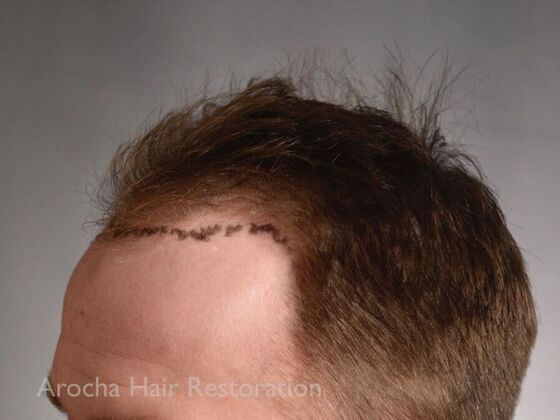 FUE Hair Restoration: Case 35 - Before