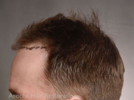FUE Hair Restoration: Case 35 - Before