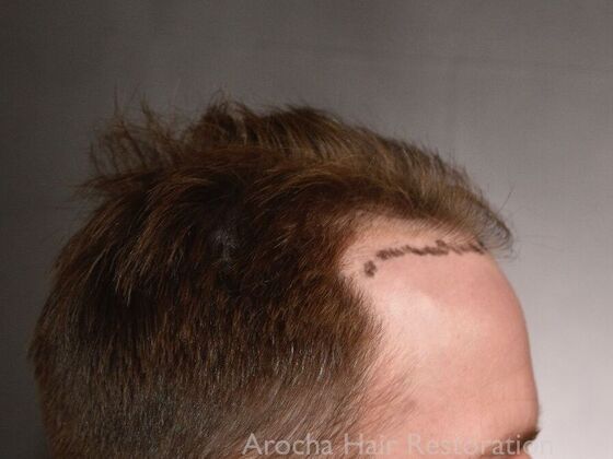 FUE Hair Restoration: Case 35 - Before