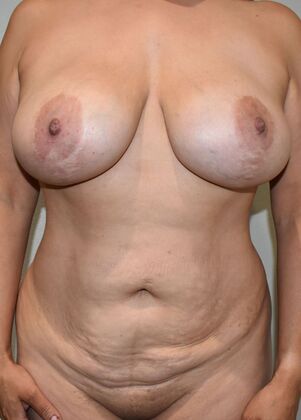 Mommy Makeover Case 305 - Before