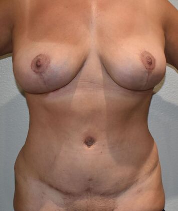 Mommy Makeover Case 305 - After