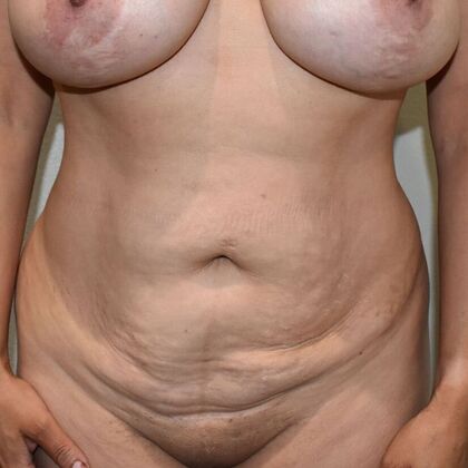 Tummy Tuck (Abdominoplasty): Case 480 - Before