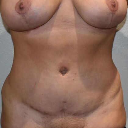 Tummy Tuck (Abdominoplasty): Case 480 - After