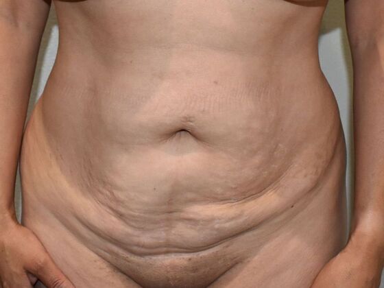 Tummy Tuck (Abdominoplasty): Case 370 - Before