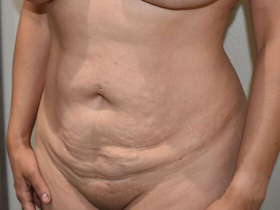 Tummy Tuck (Abdominoplasty): Case 370 - Before