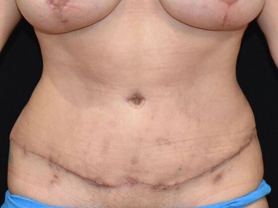 Tummy Tuck (Abdominoplasty): Case 370 - After