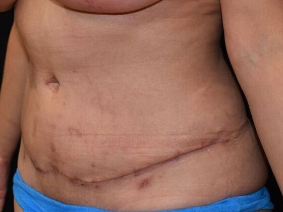 Tummy Tuck (Abdominoplasty): Case 370 - After