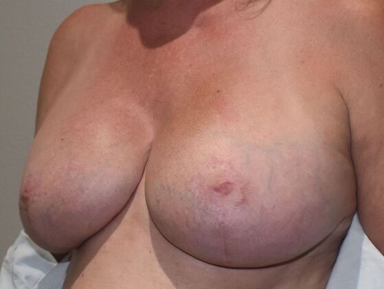 Breast Revision: Case 234 - After