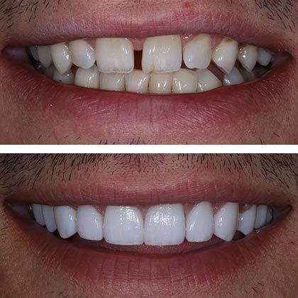 Minimal Prep Porcelain Veneers Christopher - Before