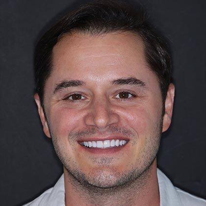 Minimal Prep Porcelain Veneers Christopher - After