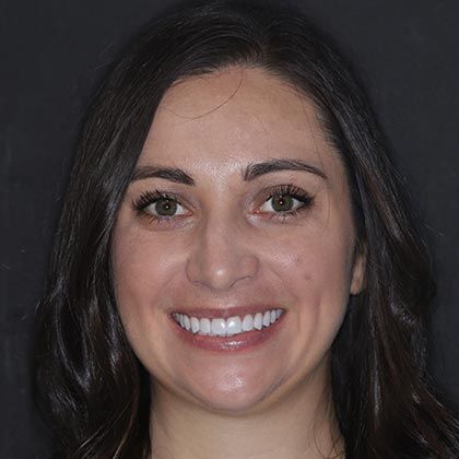 Minimal Prep Porcelain Veneers Lauren - After