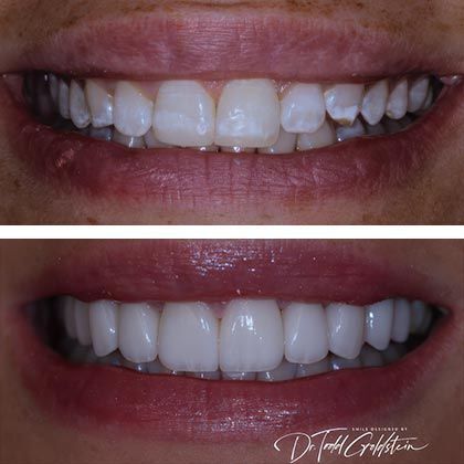 Minimal Prep Porcelain Veneers Kristin - Before