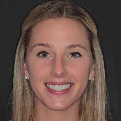 Minimal Prep Porcelain Veneers Amanda - After