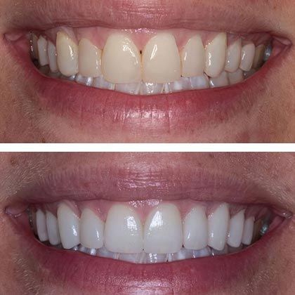 Minimal Prep Porcelain Veneers Amanda - Before