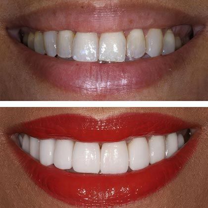 Minimal Prep Porcelain Veneers Vanessa - Before