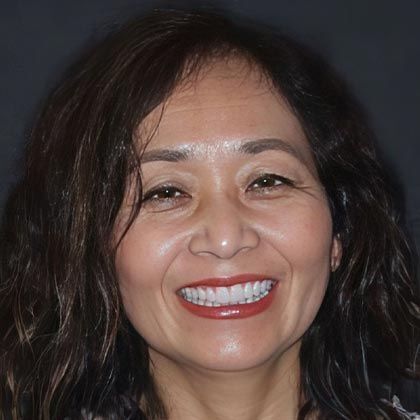 Minimal Prep Porcelain Veneers Karina - After