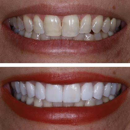 Minimal Prep Porcelain Veneers Karina - Before