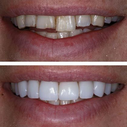 Minimal Prep Porcelain Veneers Pete - Before