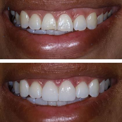 Minimal Prep Porcelain Veneers Myrka - Before