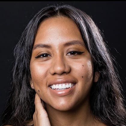 Minimal Prep Porcelain Veneers Myrka - After