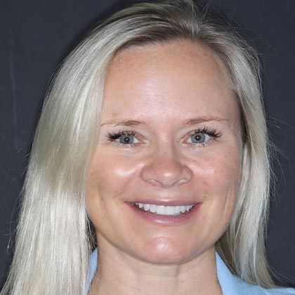 Minimal Prep Porcelain Veneers Tatiana - After