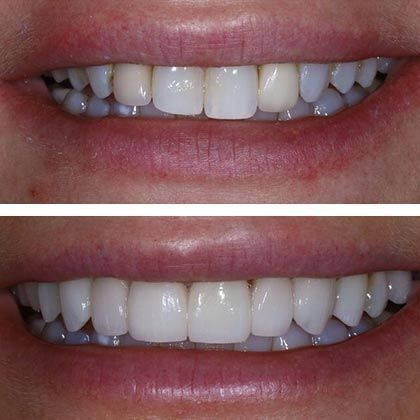 Minimal Prep Porcelain Veneers Tatiana - Before