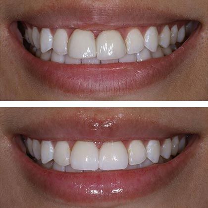 Minimal Prep Porcelain Veneers Maggie - Before